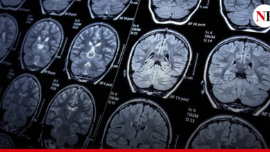 Photo of SEGÚN ESTUDIO EL CEREBRO DE LOS PACIENTES POSCOVID PIERDE TAMAÑO