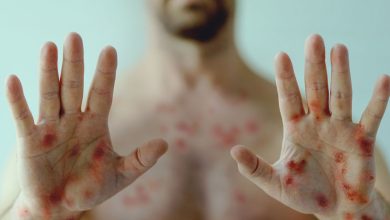 Photo of Córdoba se mantiene libre de Mpox: Secretaría de Salud niega rumores sobre un supuesto caso
