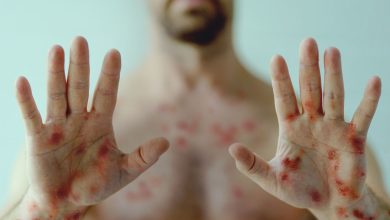 Photo of Mpox: Síntomas clave y formas de transmisión que todos deben conocer
